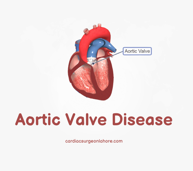 Aortic Valve Disease