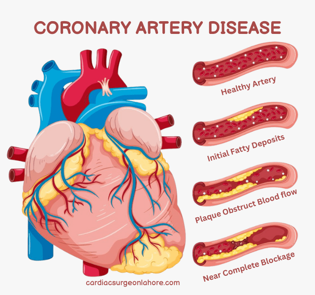 Coronary Artery Diseases