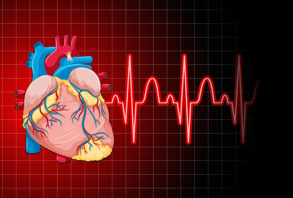 Heart Attack