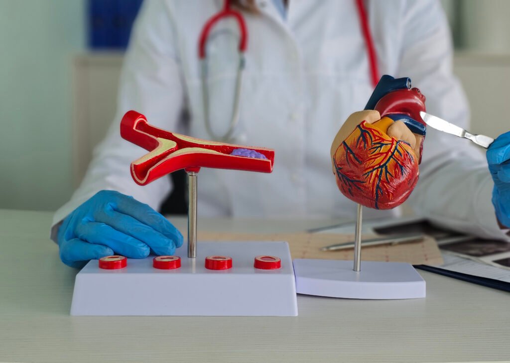 aortic aneurysm
