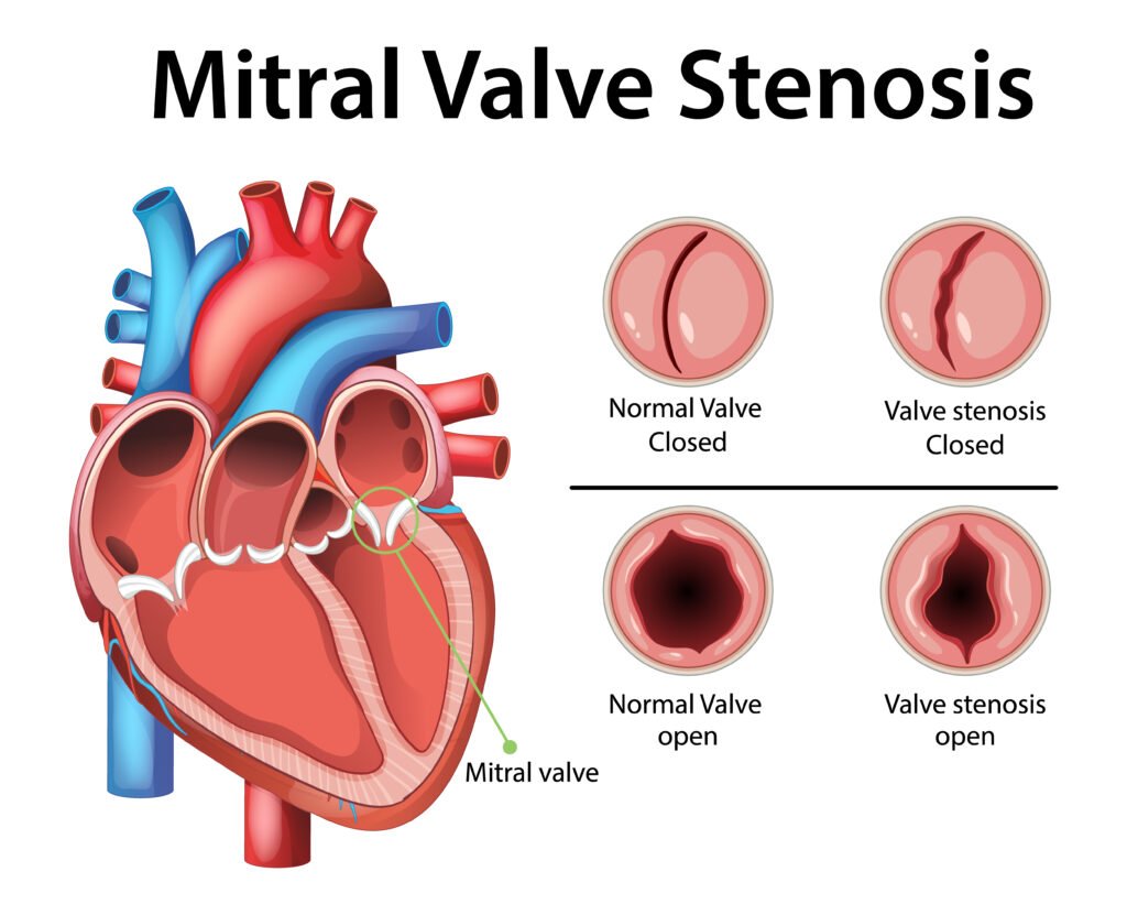 Valve